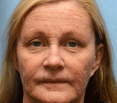 Botox Bee Venom Wrinkle Removal Cream-Last Day Promotion 75% OFF