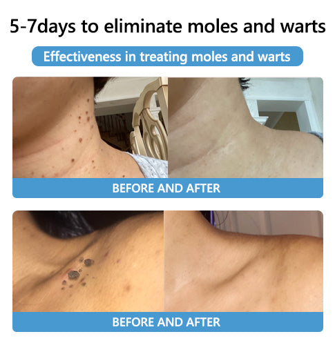 Acne Drying Lotion – Fights Inflamed & Pus-Filled Pimples Fast