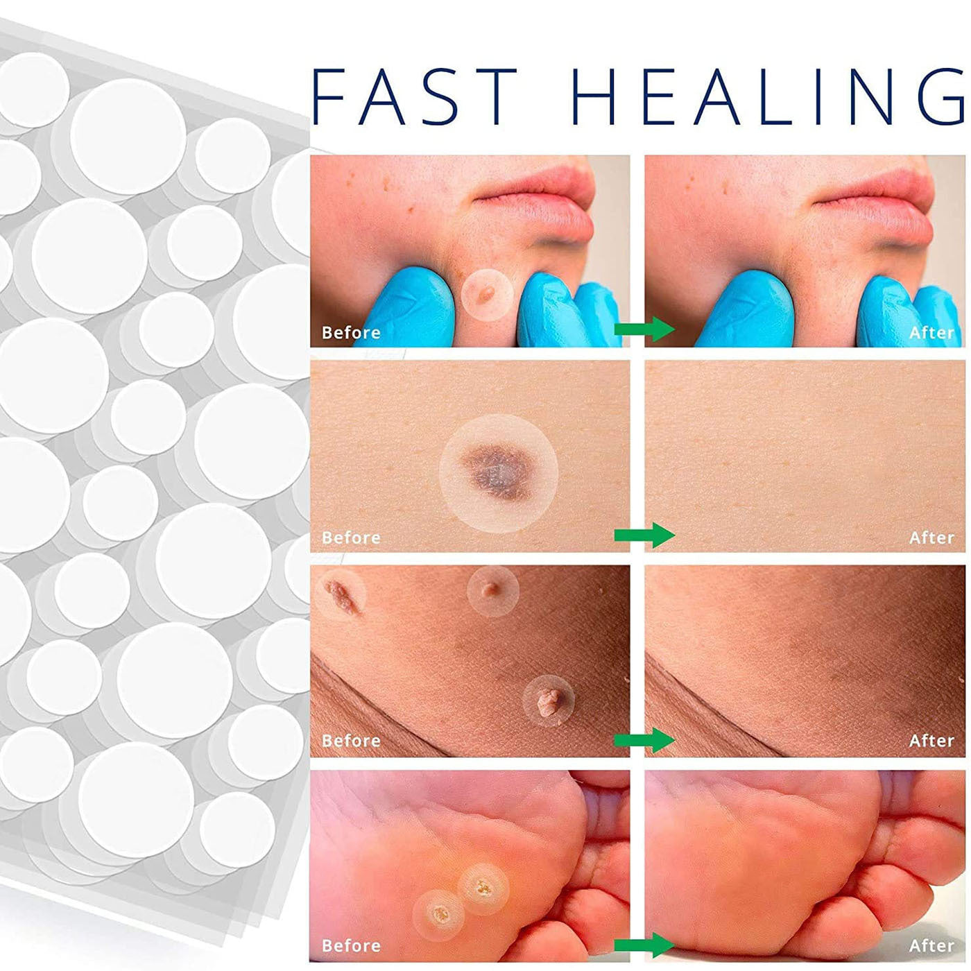 Acne sticker-Used for reducing inflammation on acne spots