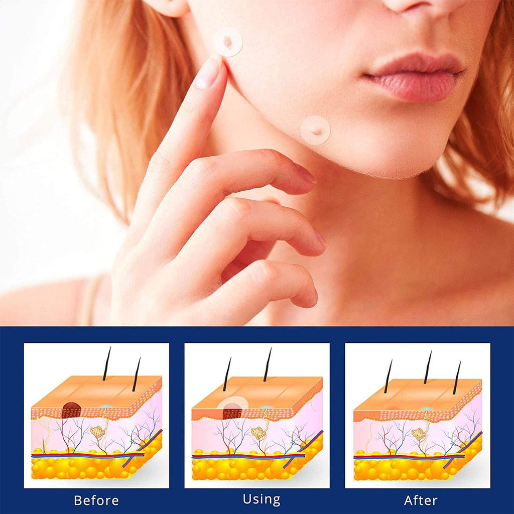 Acne sticker-Used for reducing inflammation on acne spots