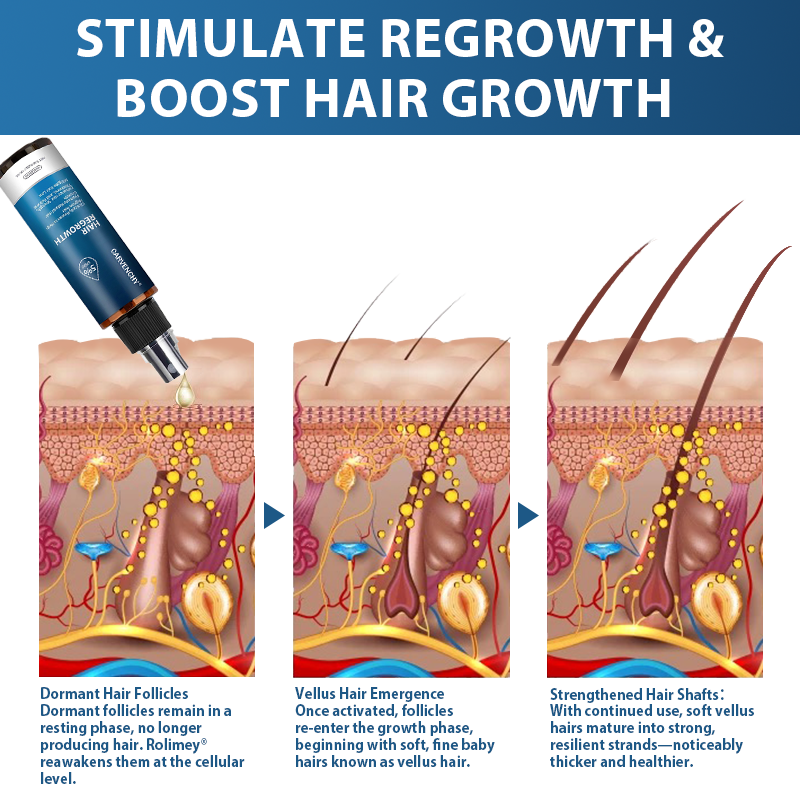 ✅🇺🇸 Developed by Trichologists：High-Concentration Minoxidil Hair Regrowth Serum