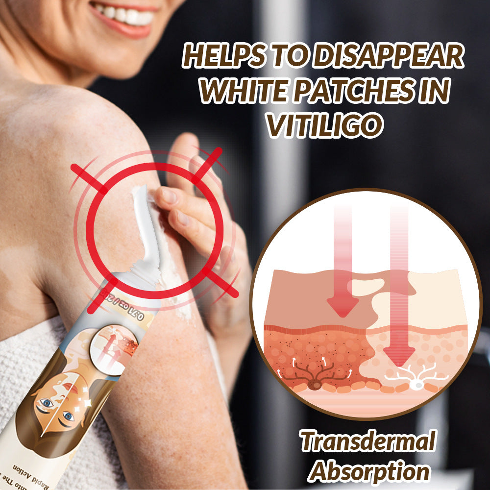 Vitiligo Repair Cream