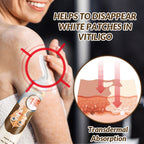 Vitiligo Repair Cream