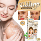 Vitiligo Repair Cream