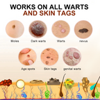 Acne Drying Lotion – Fights Inflamed & Pus-Filled Pimples Fast