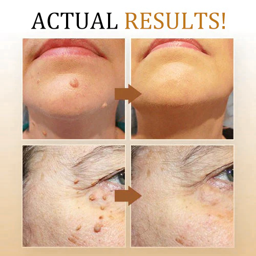 Acne Drying Lotion – Fights Inflamed & Pus-Filled Pimples Fast