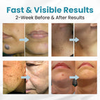 【Acne & Scar Therapy Set】 2% Salicylic Acid + High-Strength VC Essence