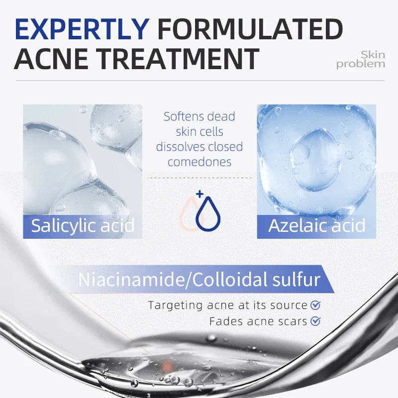 Acne Drying Lotion – Fights Inflamed & Pus-Filled Pimples Fast