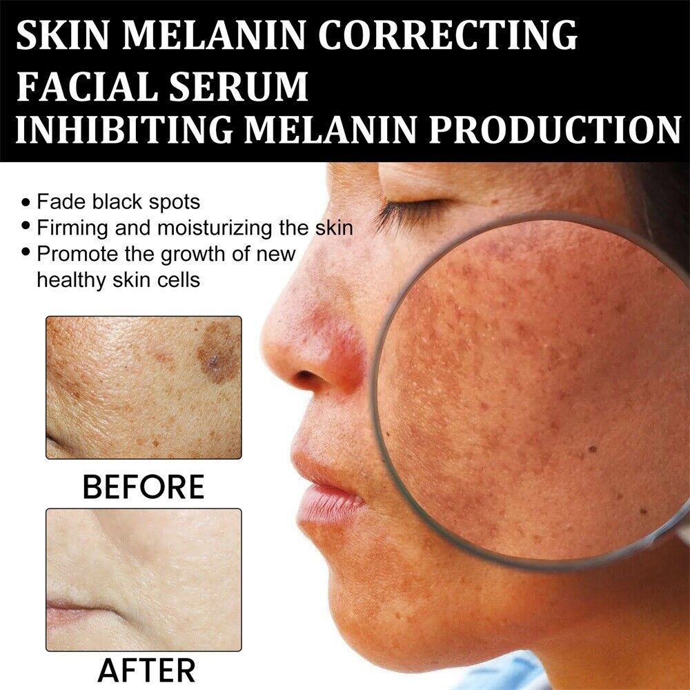 ✨Fast Dark Spot Remover- Melanin Correcting Facial Serum
