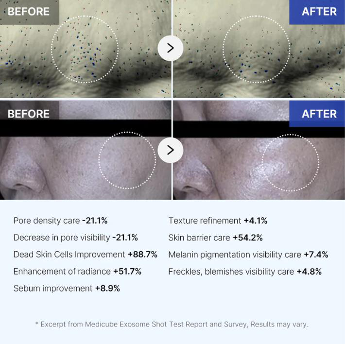 Exosome Micro-Needle Serum